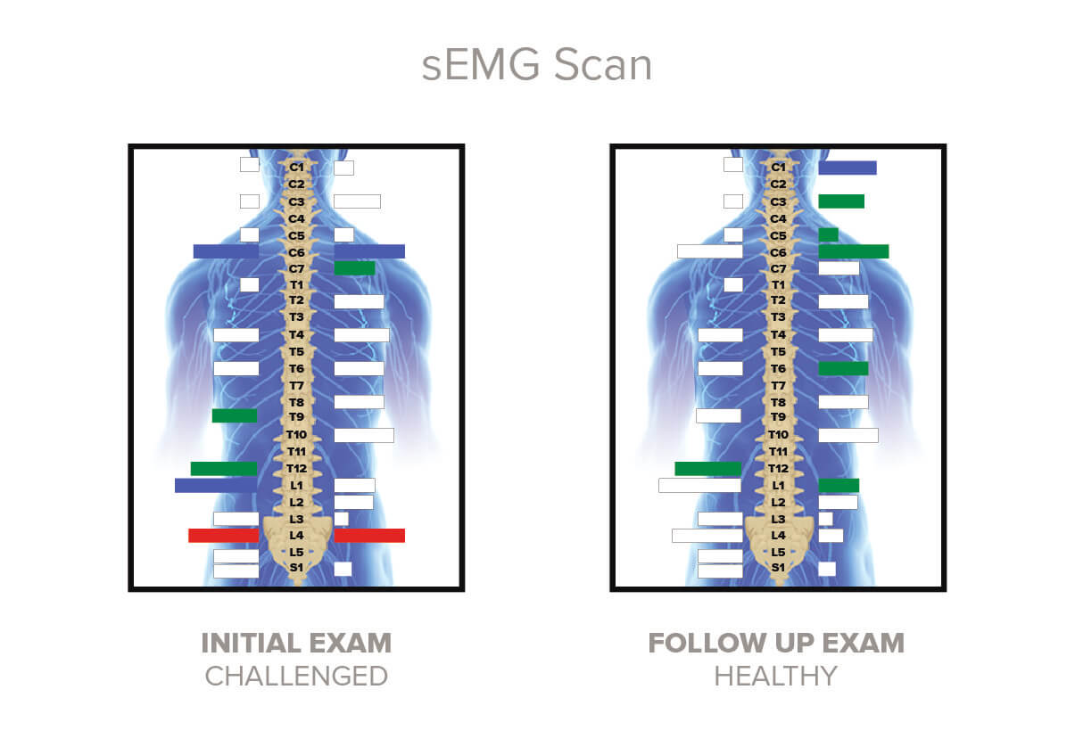 sEMG scan